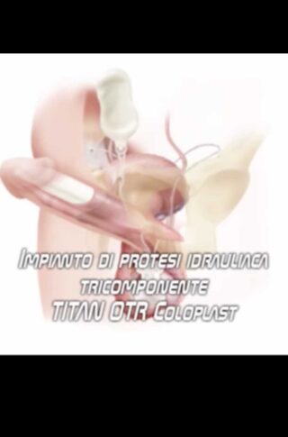 Coloplast-Titan-OTR