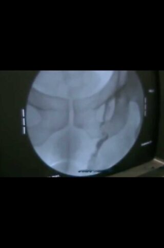 Left varicocele treatment with phlebographic technique © photo MD PhD Gabriele Antonini
