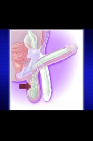 Peniena AMS-CX-700 prosthesis