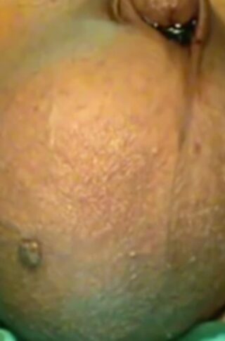 hydrocele second part © photo MD PhD Gabriele Antonini