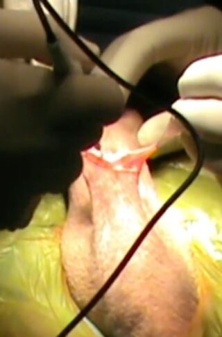 penile prosthesis implantation in a patient with ipp  © photo MD PhD Gabriele Antonini
