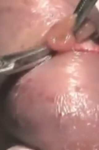 testis biopsy spermatozoa recovery © photo MD PhD Gabriele Antonini