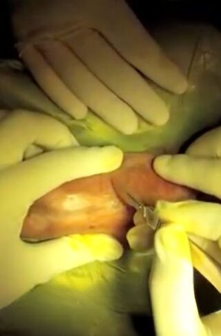 ams-700 three-component hydraulic penile prosthesis © photo MD PhD Gabriele Antonini