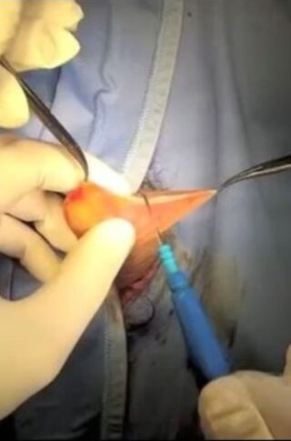short lacerated frenulum frenuloplasty © photo MD PhD Gabriele Antonini
