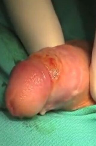 Post-circumcision keloid © photo MD PhD Gabriele Antonini