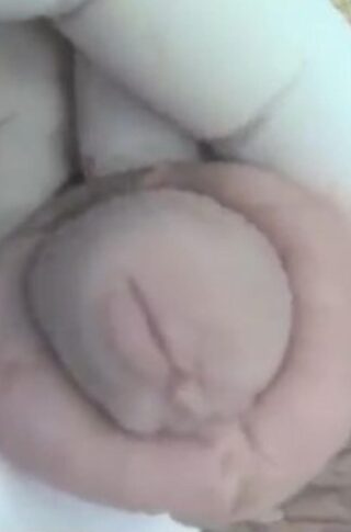 wrong circumcision keloid scar © photo MD PhD Gabriele Antonini