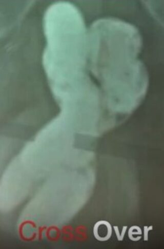 cross over malleable penile prosthesis © photo MD PhD Gabriele Antonini
