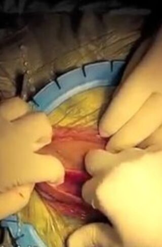 penis prosthesis erectile dysfunction © photo MD PhD Gabriele Antonini