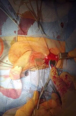 phimosis circuncision frenillo phimosis phrenuloplstica © photo MD PhD Gabriele Antonini
