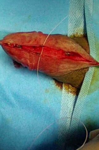 frenulum-penis-short © photo MD PhD Gabriele Antonini