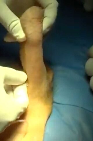 Penile-Implant-in-19-Minutes